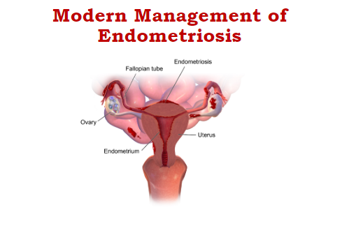 Modern_management_of_Endometriosis